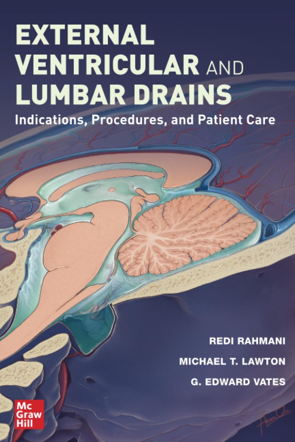 External Ventricular and Lumbar Drains