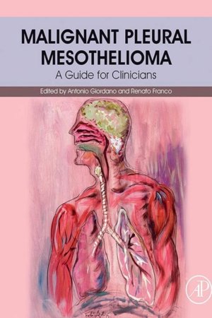 Malignant Pleural Mesothelioma PDF