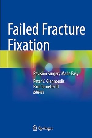 Failed Fracture Fixation: Revision Surgery Made Easy PDF
